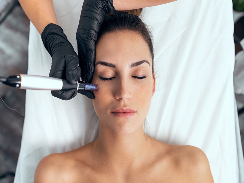 Un traitement de Microneedling réalisé sur le visage d'une femme