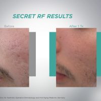 Traitement de microneedling Secret RF sur la joue d'un homme