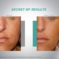 Photos du visage d'une femme après traitement Microneedling Secret RF